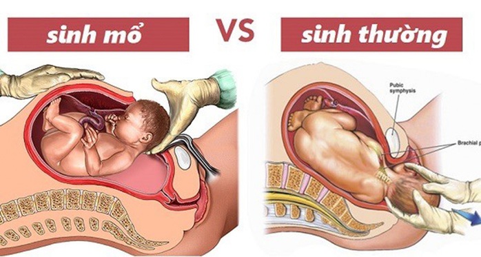 Mất con vì chọn ngày giờ sinh mổ - Ảnh 2.