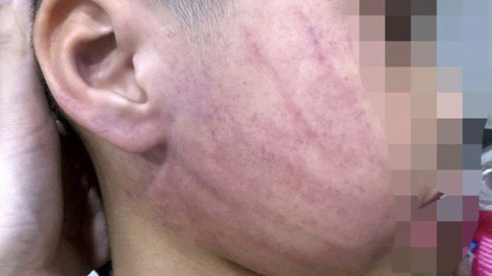 Điều tra vụ bé 4 tuổi bị giáo viên đánh tại trường mầm non T . Đ - Ảnh 1.