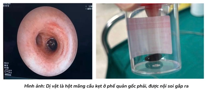 Hạt mãng cầu mắc kẹt trong phổi bé trai 1 tuổi 20 ngày - Ảnh 1.