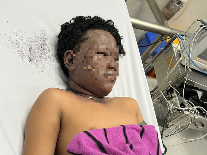 Bé trai 13 tuổi ôm mặt chạy về báo gia đình sau khi cùng bạn nghịch pháo - Ảnh 1.