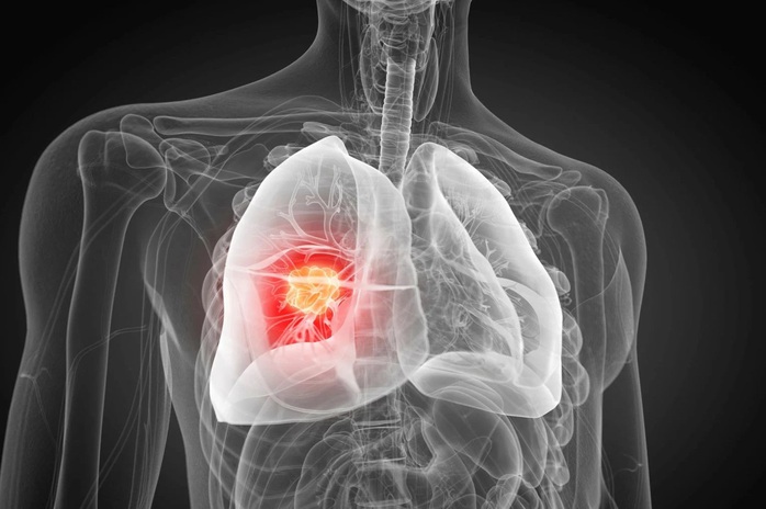 Ph&aacute;t hiện nguy&ecirc;n nh&acirc;n g&acirc;y ung thư phổi chưa từng biết - Ảnh 1.