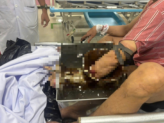 Nam thanh ni&ecirc;n v&aacute;c cả m&aacute;y xay thịt đến bệnh viện cấp cứu - Ảnh 1.