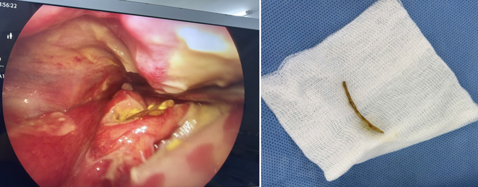 Người phụ nữ ngậm C sủi sau khi h&oacute;c xương c&aacute;  - Ảnh 1.