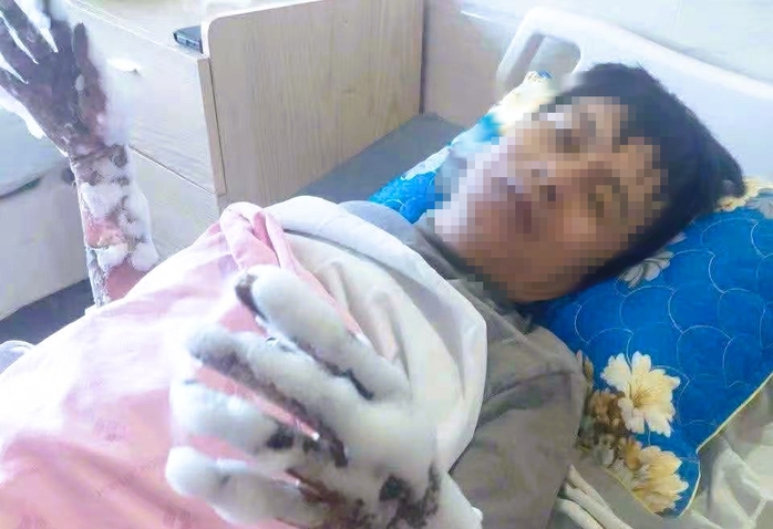 Một c&ocirc;ng nh&acirc;n bị bỏng nặng 2 tay do ph&oacute;ng điện - Ảnh 1.