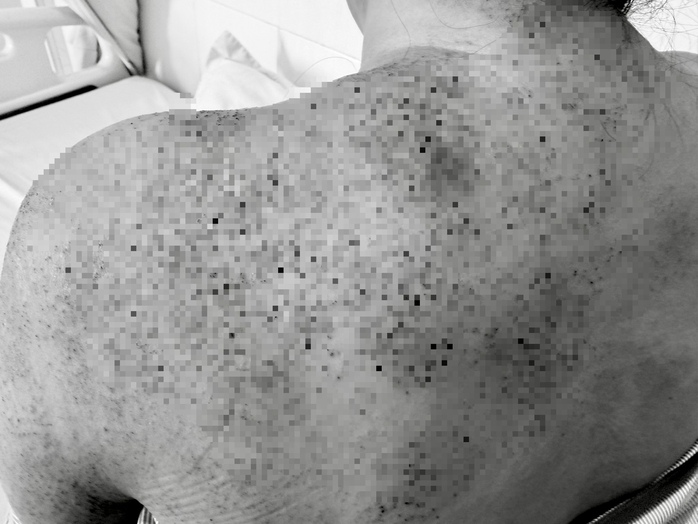 Người phụ nữ ở Vĩnh Long nhập viện cấp cứu sau khi ch&iacute;ch lể, gi&aacute;c hơi - Ảnh 1.