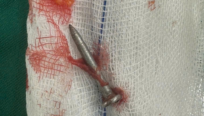 Ca cấp cứu sinh tử tại Bệnh viện Việt Nam - Cuba Đồng Hới - Ảnh 3.