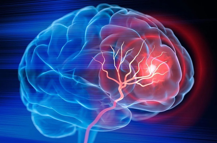 Mỹ ph&aacute;t triển phương ph&aacute;p trị đột quỵ mới, chỉ cần 1 lần truyền dịch - Ảnh 1.