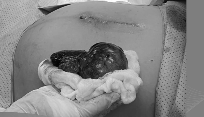 Thai lớn 34 tuần, b&aacute;c sĩ ph&aacute;t hiện khối u buồng trứng đ&atilde; hoại tử - Ảnh 1.