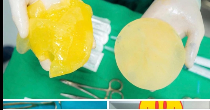 Phụ nữ đ&atilde; "tr&ugrave;ng tu" v&ograve;ng 1, c&oacute; được chơi Pickleball? - Ảnh 2.