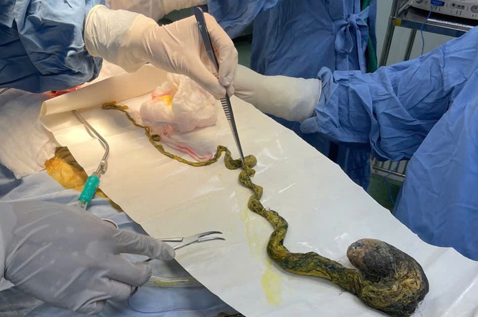 B&eacute; trai 6 tuổi phải phẫu thuật v&igrave; ăn t&oacute;c - cảnh b&aacute;o bệnh hiếm gặp - Ảnh 2.