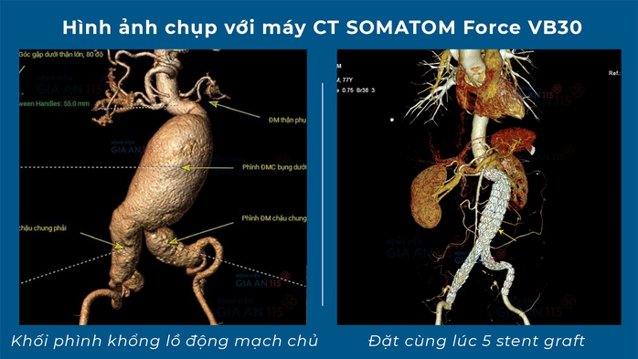 Đau bụng th&ocirc;ng thường, v&agrave;o viện đặt khẩn 5 stent c&ugrave;ng l&uacute;c - Ảnh 1.