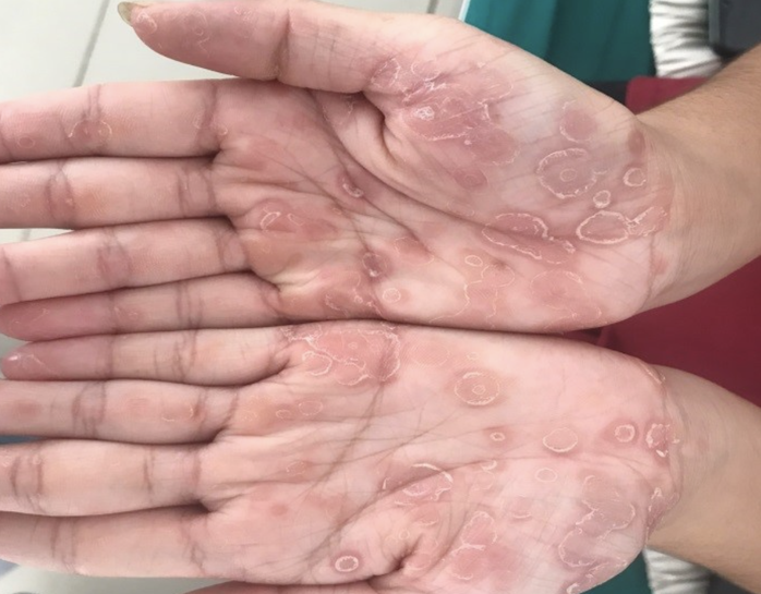 B&eacute; trai 3 tuổi bị giang mai bẩm sinh d&ugrave; kh&ocirc;ng c&oacute; triệu chứng - Ảnh 1.