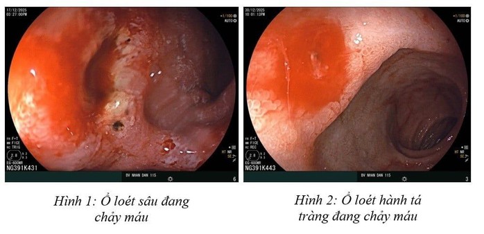 Xuất huyết dạ d&agrave;y v&igrave; stress, ăn uống thất thường ở người trẻ  - Ảnh 2.