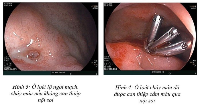 Xuất huyết dạ d&agrave;y v&igrave; stress, ăn uống thất thường ở người trẻ  - Ảnh 1.
