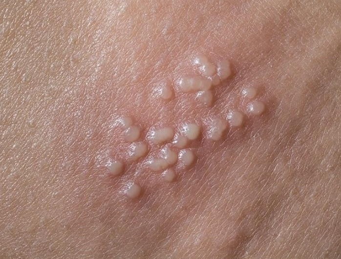 Nam sinh 18 tuổi mắc sùi mào gà sau quan hệ đường hậu môn - Ảnh 1.