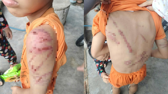 X&oacute;t xa H&igrave;nh ảnh ch&aacute;u trai 10 tuổi bị cha ruột đ&aacute;nh con bầm t&iacute;m khắp người - Ảnh 1.