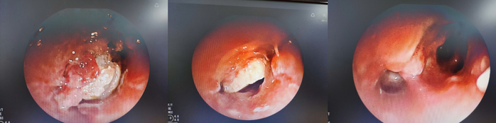 Thiếu ni&ecirc;n 15 tuổi h&oacute;c hạt hạnh nh&acirc;n trong phế quản 7 ng&agrave;y - Ảnh 1.