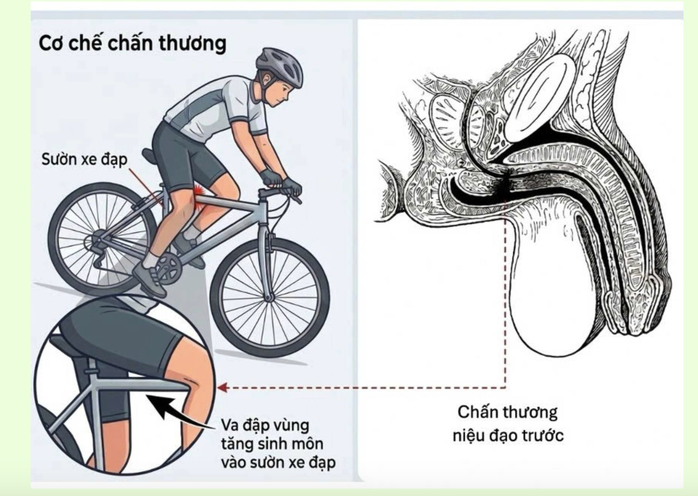 Cảnh b&aacute;o chấn thương niệu đạo ở trẻ em sau tai nạn xe đạp - Ảnh 1.
