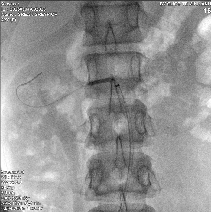 Một nữ sinh suy thận ở tuổi 22, hồi chu&ocirc;ng cảnh b&aacute;o cho người trẻ - Ảnh 2.