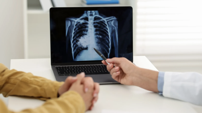 TPHCM sẽ triển khai chiến dịch 100 ng&agrave;y s&agrave;ng lọc lao chủ động trong cộng đồng - Ảnh 1.