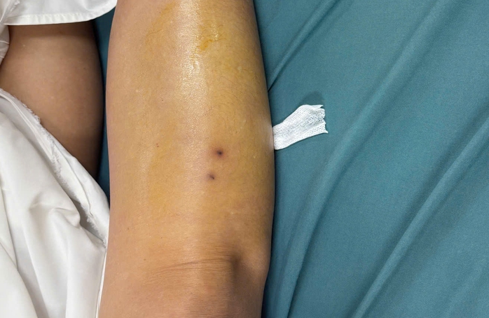 Người phụ nữ ở T&acirc;y Ninh bị rắn cắn khi phun thuốc cỏ - Ảnh 1.