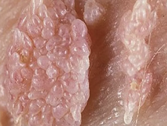 Người đ&agrave;n &ocirc;ng gần 70 tuổi mắc s&ugrave;i m&agrave;o g&agrave; sau quan hệ kh&ocirc;ng an to&agrave;n - Ảnh 1.