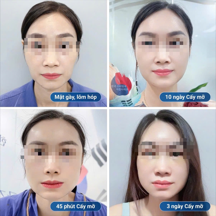 Hóp má, teo mô sau thẩm mỹ: Biến chứng “âm thầm” nhưng nguy hiểm - Ảnh 1.