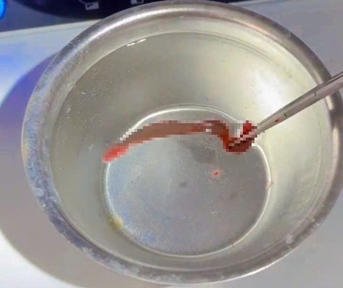 Dị vật không ngờ bám nhiều ngày trong mũi bệnh nhân 38 tuổi - Ảnh 2.