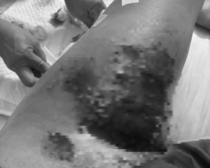 Xe tải 10 tấn ch&egrave;n qua, c&ocirc; g&aacute;i su&yacute;t mất ch&acirc;n v&igrave; chấn thương &ldquo;ẩn&rdquo; - Ảnh 1.