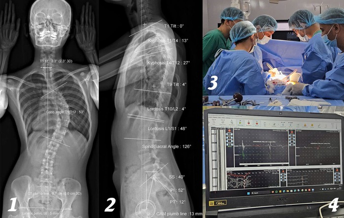 Soi gương thấy lưng c&oacute; dấu hiệu lạ, c&ocirc; g&aacute;i 18 tuổi sốc khi biết cột sống đ&atilde; cong 53 độ - Ảnh 1.