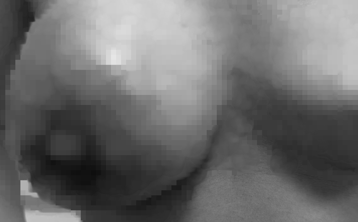 Du học sinh về nước mổ u tuyến v&uacute; 18 cm, bảo tồn to&agrave;n bộ tuyến v&uacute; - Ảnh 1.