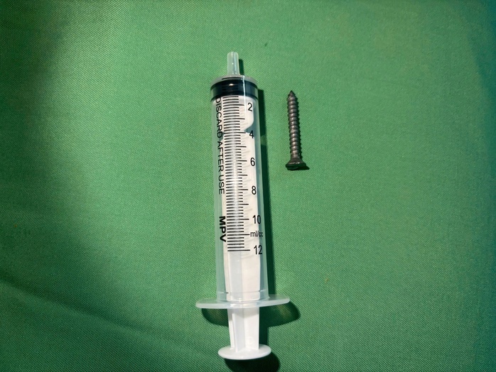 Dị vật nguy hiểm trong dạ d&agrave;y bệnh nhi 21 th&aacute;ng tuổi - Ảnh 1.