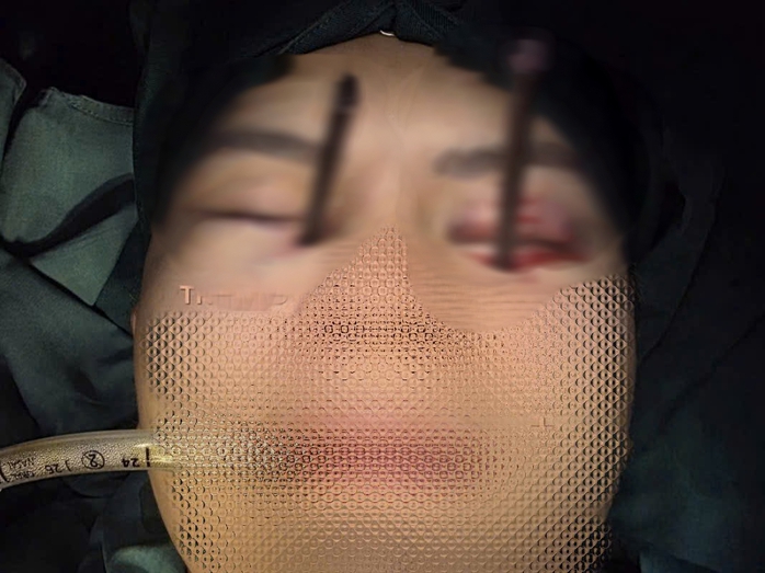 Cứu nam thanh ni&ecirc;n bị dị vật đ&acirc;m s&acirc;u hốc mắt - Ảnh 1.