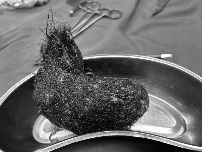 B&uacute;i t&oacute;c "khủng" trong dạ d&agrave;y bệnh nhi 7 tuổi - Ảnh 2.