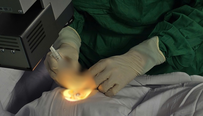 Một trường hợp cấp cứu hi hữu: bệnh nh&acirc;n bị ong ch&iacute;ch xuy&ecirc;n gi&aacute;c mạc - Ảnh 1.