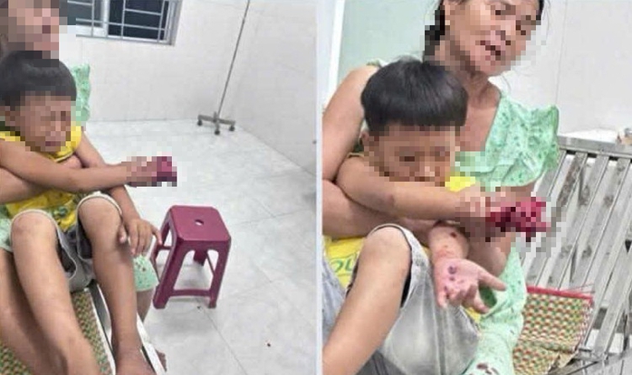 Ch&aacute;u b&eacute; bị dập b&agrave;n tay nghi do điện thoại nổ l&uacute;c sạc pin - Ảnh 1.