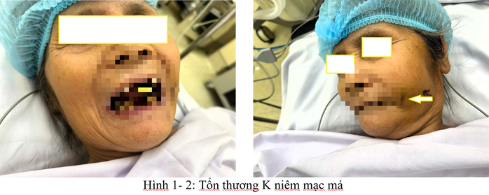 Phát hiện ung thư từ một vết loét miệng - Ảnh 1.