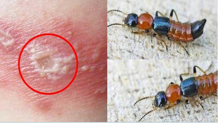 Độc tố kiến ba khoang lan rộng từ cú đập tay vô thức - Ảnh 1.