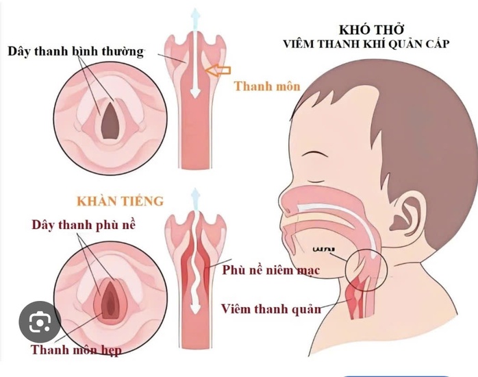 Sai lầm của cha mẹ l&agrave;m trẻ vi&ecirc;m thanh quản m&ugrave;a h&egrave; - Ảnh 2.