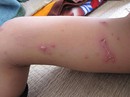 Nằm bệnh viện, bệnh nhân bị kiến ba khoang tấn công Nằm bệnh viện, bệnh nhân bị kiến ba khoang tấn công