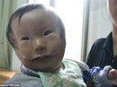 Cậu bé như có 2 gương mặt vì căn bệnh lạ Cậu bé như có 2 gương mặt vì căn bệnh lạ