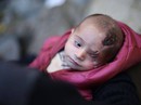 Syria: Xót thương bé 3 tháng tuổi chỉ còn một mắt Syria: Xót thương bé 3 tháng tuổi chỉ còn một mắt