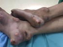 Người đàn ông bị hàng trăm cục vôi ăn hủy xương Người đàn ông bị hàng trăm cục vôi ăn hủy xương