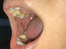 Một phụ nữ Bến Tre mắc bệnh cực kỳ hiếm gặp Một phụ nữ Bến Tre mắc bệnh cực kỳ hiếm gặp