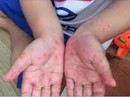 Mùa tựu trường, coi chừng bệnh trẻ em Mùa tựu trường, coi chừng bệnh trẻ em
