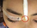 Cô gái bị kim khâu chui vào mắt trong lúc nhấn mí Cô gái bị kim khâu chui vào mắt trong lúc nhấn mí