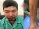 Uống thuốc Đông y "ngậm" corticoid, người đàn ông "to không đều" Uống thuốc Đông y "ngậm" corticoid, người đàn ông "to không đều"
