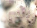 Nam sinh mọc mụn mủ chi chít sau bôi kem trị trứng cá Nam sinh mọc mụn mủ chi chít sau bôi kem trị trứng cá