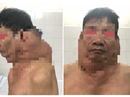 "Người gấu" được phẫu thuật thành công khối u khổng lồ "Người gấu" được phẫu thuật thành công khối u khổng lồ