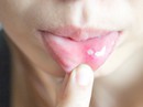 Khi nào nổi đẹn là nghiêm trọng? Khi nào nổi đẹn là nghiêm trọng?
